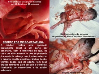 ABORTO POR MICRO-CESARIANAABORTO POR MICRO-CESARIANA
O médico realiza uma operação
exatamente igual a um parto por
cesariana, com a diferença de que, no
caso do abortamento, o que se pretende
é a morte da criança que é enforcada com
o próprio cordão umbilical. Muitos bebês,
vítimas desse tipo de aborto, têm seus
órgãos retirados para pesquisa científica,
fabricação de cosméticos e de sabão/
sabonete.
Bebê abortado às 24 semanas
de gravidez por Micro-Cesariana (Hysteretomia)
Detalhe da foto anterior...
Foto (National Geographic Channel)
em 4D. Bebê com 28 semanas
 