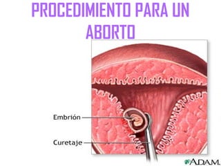 PROCEDIMIENTO PARA UN
ABORTO
 