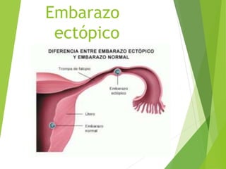 Embarazo
ectópico
 