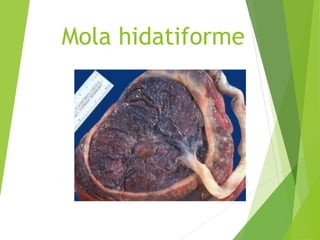 Mola hidatiforme
 