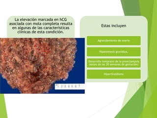 La elevación marcada en hCG
asociada con mola completa resulta
en algunas de las características
clínicas de esta condición.
Estas incluyen
Agrandamiento de ovario
Hiperemesis gravídica,
Desarrollo temprano de la preeclampsia
(antes de las 20 semanas de gestación)
Hipertiroidismo
 
