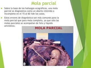 Mola parcial
 Sobre la base de los hallazgos ecográficos, una mola
parcial se diagnostica como un aborto retenido o
incompleto en el 15 al 60 %de los casos.
 Estos errores de diagnóstico son más comunes para la
mola parcial que para mola completa, ya que sólo las
molas parciales se acompañan de feto y líquido
amniótico.
 