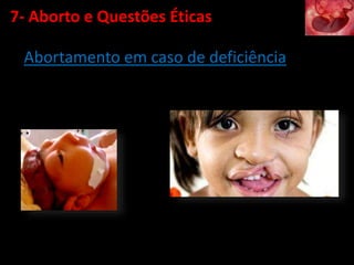 Abortamento em caso de deficiência
7- Aborto e Questões Éticas
 