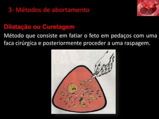 Dilatação ou Curetagem
Método que consiste em fatiar o feto em pedaços com uma
faca cirúrgica e posteriormente proceder a uma raspagem.
3- Métodos de abortamento
 