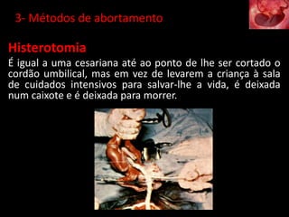 Histerotomia
É igual a uma cesariana até ao ponto de lhe ser cortado o
cordão umbilical, mas em vez de levarem a criança à sala
de cuidados intensivos para salvar-lhe a vida, é deixada
num caixote e é deixada para morrer.
3- Métodos de abortamento
 