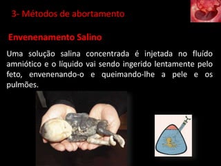 Envenenamento Salino
Uma solução salina concentrada é injetada no fluído
amniótico e o líquido vai sendo ingerido lentamente pelo
feto, envenenando-o e queimando-lhe a pele e os
pulmões.
3- Métodos de abortamento
 