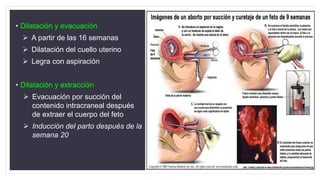 • Dilatación y evacuación
 A partir de las 16 semanas
 Dilatación del cuello uterino
 Legra con aspiración
• Dilatación y extracción
 Evacuación por succión del
contenido intracraneal después
de extraer el cuerpo del feto
 Inducción del parto después de la
semana 20
 