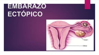 EMBARAZO
ECTÓPICO
 