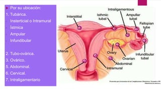  Por su ubicación:
1. Tubárica.
- Insterticial o Intramural
- Ístmica
- Ampular
- Infundibular
2. Tubo-ovárica.
3. Ovárico.
5. Abdominal.
6. Cervical.
7. Intraligamentario
 