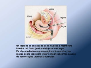 Un legrado es el raspado de la mucosa o membrana
interior del útero (endometrio) con una legra.
Es el procedimiento ginecológico más común y se
realiza sobre todo para tratar o diagnosticar las causas
de hemorragias uterinas anormales.
 