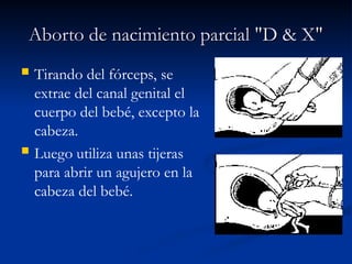 Aborto de nacimiento parcial "D & X"
Aborto de nacimiento parcial "D & X"
 Tirando del fórceps, se
extrae del canal genital el
cuerpo del bebé, excepto la
cabeza.
 Luego utiliza unas tijeras
para abrir un agujero en la
cabeza del bebé.
 