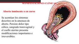 MANIFESTACIONES CLÍNICAS
Aborto inminente o en curso
Se acentúan los síntomas
descritos en la amenaza de
aborto. Persiste dolor tipo
cólico, sangrado transvaginal y
el cuello uterino presenta
modificaciones importantes e
irreversibles.
 