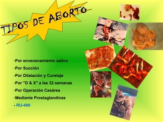 -Por envenenamiento salino
-Por Succión
-Por Dilatación y Curetaje
-Por "D & X" a las 32 semanas
-Por Operación Cesárea
-Mediante Prostaglandinas
- RU-486
 