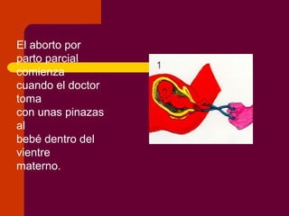 El aborto por
parto parcial
comienza
cuando el doctor
toma
con unas pinazas
al
bebé dentro del
vientre
materno.
 