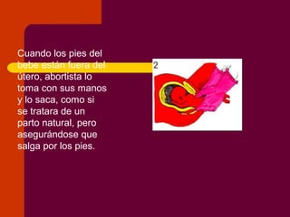 Cuando los pies del
bebe están fuera del
útero, abortista lo
toma con sus manos
y lo saca, como si
se tratara de un
parto natural, pero
asegurándose que
salga por los pies.
 