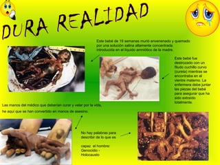 Este bebé de 19 semanas murió envenenado y quemado
por una solución salina altamente concentrada
introducida en el líquido amniótico de la madre.
Este bebé fue
destrozado con un
filudo cuchillo curvo
(cureta) mientras se
encontraba en el
vientre materno. La
enfermera debe juntar
las piezas del bebé
para asegurar que ha
sido extraído
totalmente.
Las manos del médico que deberían curar y velar por la vida,
he aquí que se han convertido en manos de asesino.
No hay palabras para
describir de lo que es
capaz el hombre:
Genocidio -
Holocausto
 