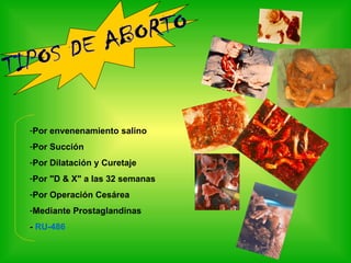 Aborto diapositivas-