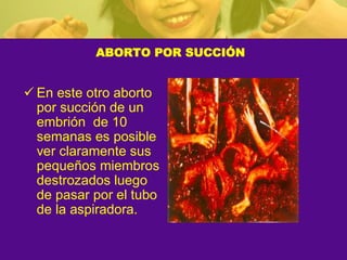 ABORTO POR SUCCIÓN
ü En este otro aborto
por succión de un
embrión de 10
semanas es posible
ver claramente sus
pequeños miembros
destrozados luego
de pasar por el tubo
de la aspiradora.
 