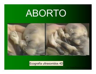 ABORTO
Ecografía ultrasonidos 4D
Lic. Teresa Garzon Cardozo
 