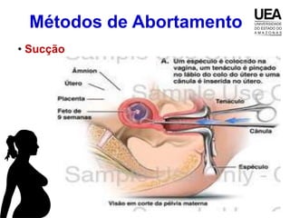 Métodos de Abortamento
• Sucção
 
