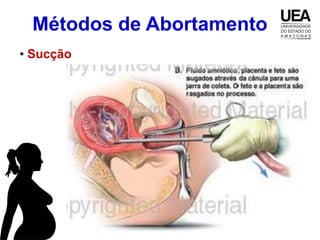 Métodos de Abortamento
• Sucção
 