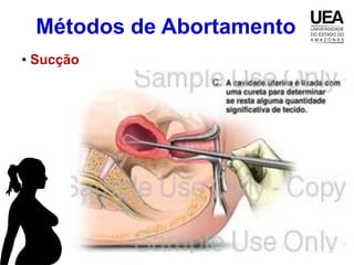 Métodos de Abortamento
• Sucção
 