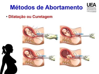Métodos de Abortamento
• Dilatação ou Curetagem
 