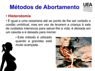 Métodos de Abortamento
• Histerotomia
• É igual a uma cesariana até ao ponto de lhe ser cortado o
cordão umbilical, mas em vez de levarem a criança à sala
de cuidados intensivos para salvar-lhe a vida, é deixada em
um caixote e é deixada para morrer.
      • Este método é utilizado
      quando a gravidez está
      muito avançada.
 