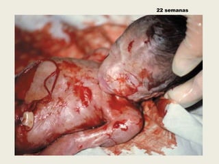 22 semanas
 