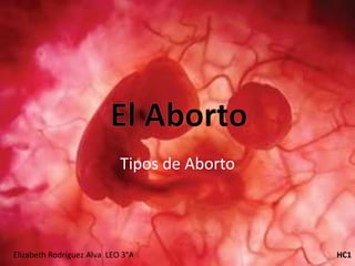 Tipos de Aborto
Elizabeth Rodríguez Alva LEO 3°A HC1
 