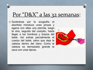 Por “D&X” a las 32 semanas:
O Guiándose por la ecografía el
abortista introduce unas pinzas y
agarra con ellas una piernita, luego
la otra, seguida del cuerpito, hasta
llegar a los hombros y brazos del
bebé. Así extrae parcialmente el
cuerpo del bebé, salvo que deja la
cabeza dentro del útero. Como la
cabeza es demasiado grande la
saca con unas tijeras.
 