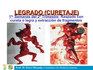 LEGRADO (CURETAJE) 1ª s  Semanas del 2º Trimestre : Raspado con cureta o legra y extracción de fragmentos 