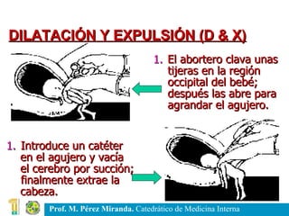 El abortero clava unas tijeras en la región occipital del bebé; después las abre para agrandar el agujero. Introduce un catéter  en el agujero y vacía  el cerebro por succión; finalmente extrae la  cabeza.  DILATACIÓN Y EXPULSIÓN (D & X) 
