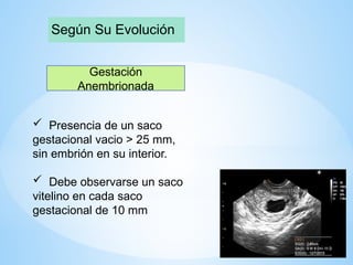 Según Su Evolución
Gestación
Anembrionada
 Presencia de un saco
gestacional vacio > 25 mm,
sin embrión en su interior.
 Debe observarse un saco
vitelino en cada saco
gestacional de 10 mm
 