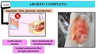 ABORTO COMPLETO
Expulsión : feto, placenta, membranas
Cuello uterino
cerrado
Útero disminuido de
tamaño/contraído
Cavidad endometrial libre
de tejido placentario
 