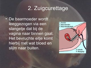 De baarmoeder wordt leeggezogen via een slangetje dat bij de vagina naar binnen gaat. Het bevruchte eitje komt hierbij met wat bloed en slijm naar buiten. 2. Zuigcurettage 