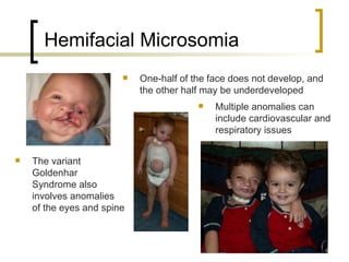 <ul><li>The variant Goldenhar Syndrome also involves anomalies of the eyes and spine </li></ul>Hemifacial Microsomia <ul><...