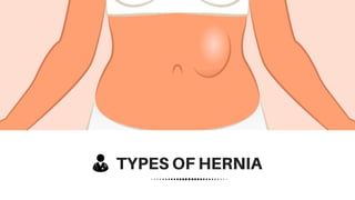 TYPES OF HERNIA
 