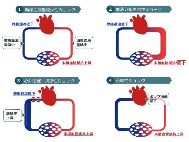 ショックについて