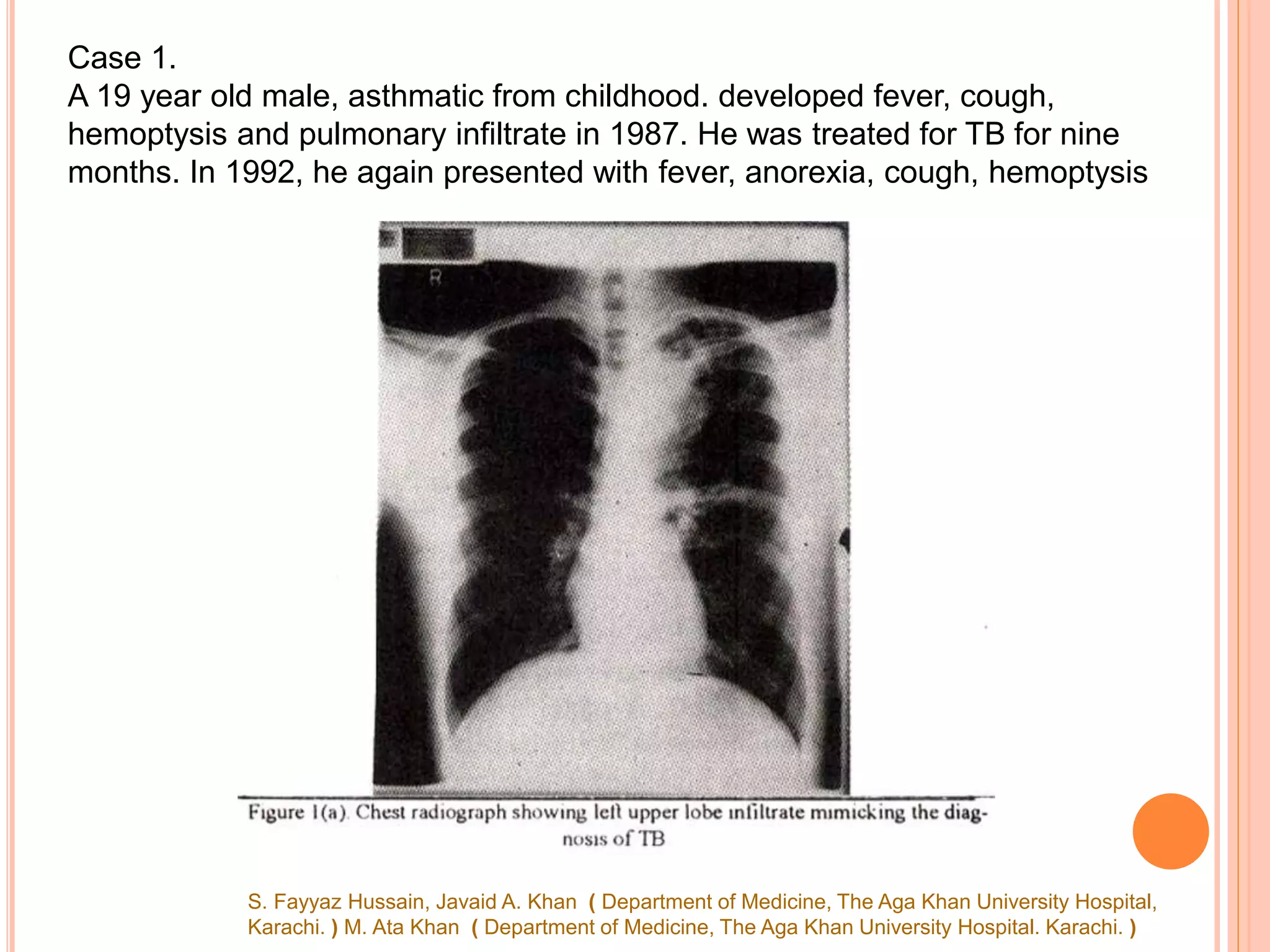 Case 1.
A 19 year old male, asthmatic from childhood. developed fever, cough,
hemoptysis and pulmonary infiltrate in 1987. He was treated for TB for nine
months. In 1992, he again presented with fever, anorexia, cough, hemoptysis
S. Fayyaz Hussain, Javaid A. Khan ( Department of Medicine, The Aga Khan University Hospital,
Karachi. ) M. Ata Khan ( Department of Medicine, The Aga Khan University Hospital. Karachi. )
 