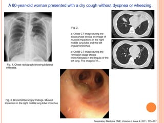 Fig. 1. Chest radiograph showing bilateral
infiltrates.
Fig. 2.
a: Chest CT image during the
acute phase shows an image of
mucoid impactions in the right
middle lung lobe and the left
lingular bronchus.
b: Chest CT image during the
remission stage shows
bronchiectasis in the lingula of the
left lung. The image of m...
Fig. 3. Bronchofiberscopy findings. Mucoid
impaction in the right middle lung lobe bronchus
Respiratory Medicine CME, Volume 4, Issue 4, 2011, 175–177
A 60-year-old woman presented with a dry cough without dyspnea or wheezing.
 