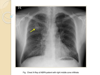 Fig. Chest X-Ray of ABPA patient with right middle zone infiltrate
 