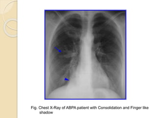 Fig. Chest X-Ray of ABPA patient with Consolidation and Finger like
shadow
 