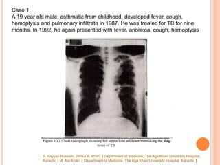 Case 1.
A 19 year old male, asthmatic from childhood. developed fever, cough,
hemoptysis and pulmonary infiltrate in 1987. He was treated for TB for nine
months. In 1992, he again presented with fever, anorexia, cough, hemoptysis
S. Fayyaz Hussain, Javaid A. Khan ( Department of Medicine, The Aga Khan University Hospital,
Karachi. ) M. Ata Khan ( Department of Medicine, The Aga Khan University Hospital. Karachi. )
 