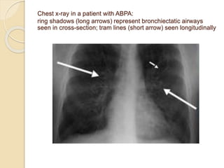Chest x-ray in a patient with ABPA:
ring shadows (long arrows) represent bronchiectatic airways
seen in cross-section; tram lines (short arrow) seen longitudinally
 