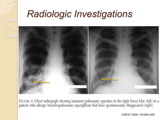 Radiologic Investigations
CHEST 2009; 135:805–826
 