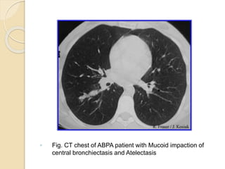 ◦ Fig. CT chest of ABPA patient with Mucoid impaction of
central bronchiectasis and Atelectasis
 
