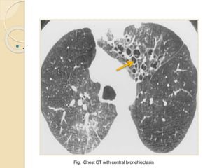  .
Fig. Chest CT with central bronchiectasis
 