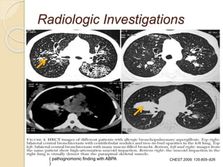 Radiologic Investigations
CHEST 2009; 135:805–826( pathognomonic finding with ABPA
)
 