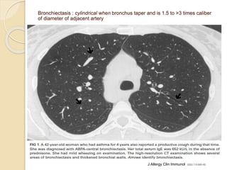 Bronchiectasis : cylindrical when bronchus taper and is 1.5 to >3 times caliber
of diameter of adjacent artery
J Allergy Clin Immunol 2002;110:685-92.
 